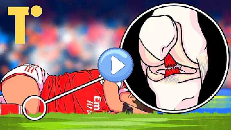 Play video: Women are more prone to ACL injuries than men due to several factors, including anatomical differences such as a wider pelvis and a greater Q-angle, which can affect knee alignment. Hormonal variations, particularly involving estrogen, may also influence ligament laxity. Additionally, differences in muscle strength, neuromuscular control, and movement patterns during physical activities can contribute to a higher risk of ACL injuries in women. Video thumb: Women are more prone to ACL injuries than men due to several factors, including anatomical differences such as a wider pelvis and a greater Q-angle, which can affect knee alignment. Hormonal variations, particularly involving estrogen, may also influence ligament laxity. Additionally, differences in muscle strength, neuromuscular control, and movement patterns during physical activities can contribute to a higher risk of ACL injuries in women.