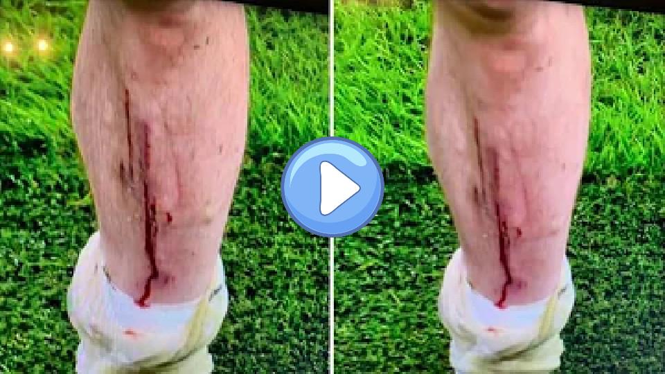 Video thumb: Warning: Video/picture of Hojbjerg's horrific injury