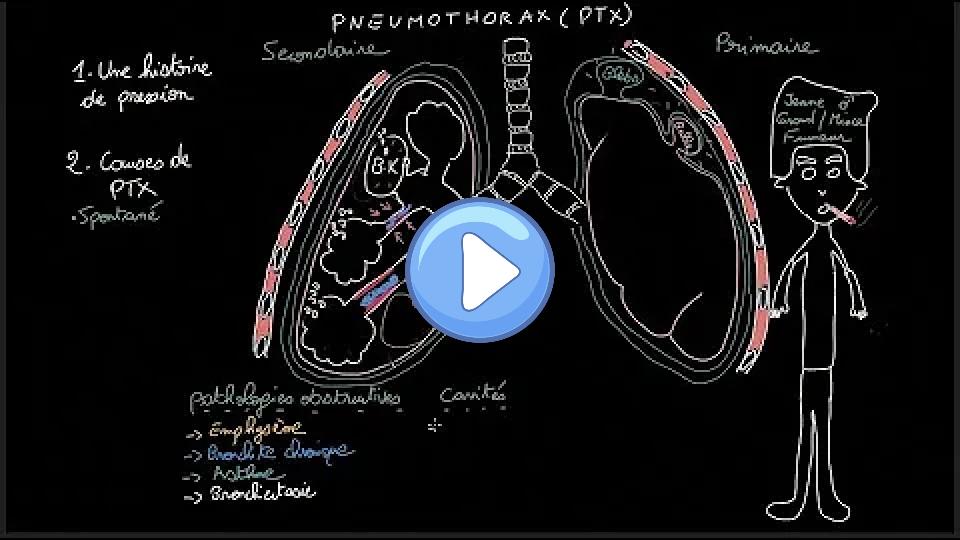 Video thumb: Pneumothorax - Doctor Synapse