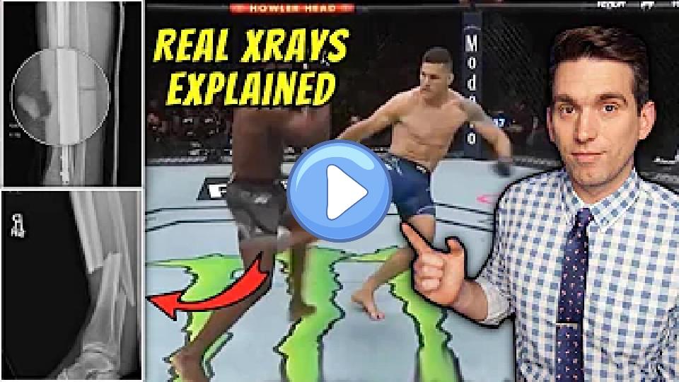 Play video: Chris Weidman Shares Real X-rays of Broken Leg from UFC 261 - Doctor Explains Images Video thumb: Chris Weidman Shares Real X-rays of Broken Leg from UFC 261 - Doctor Explains Images