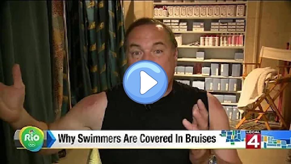 Video thumb: Why are swimmers covered in bruises?