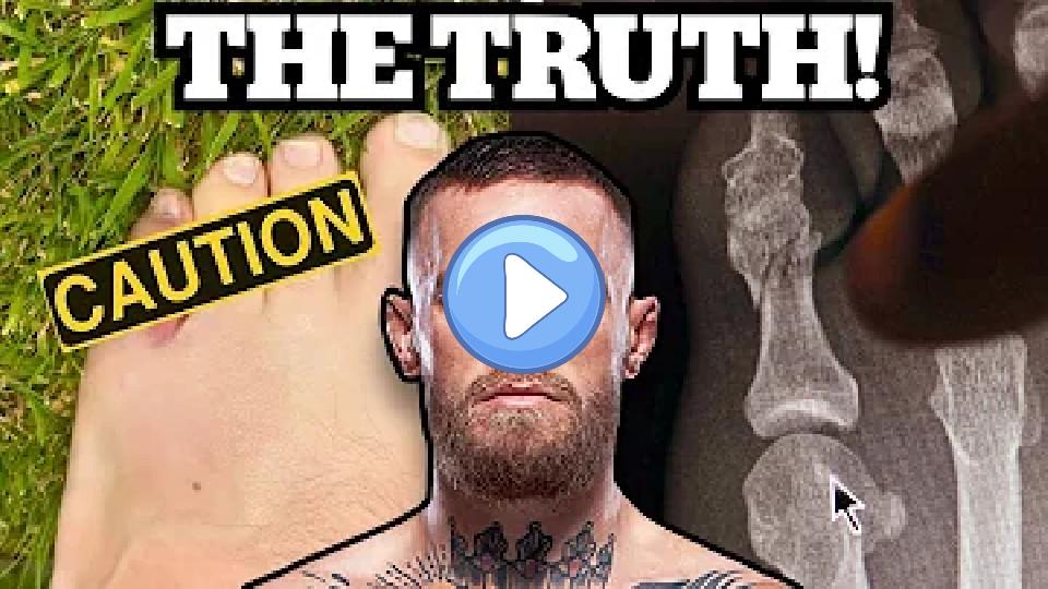 Video thumb: Conor McGregor Broke His Pinky Toe and Couldn't Fight - Doctor Explains