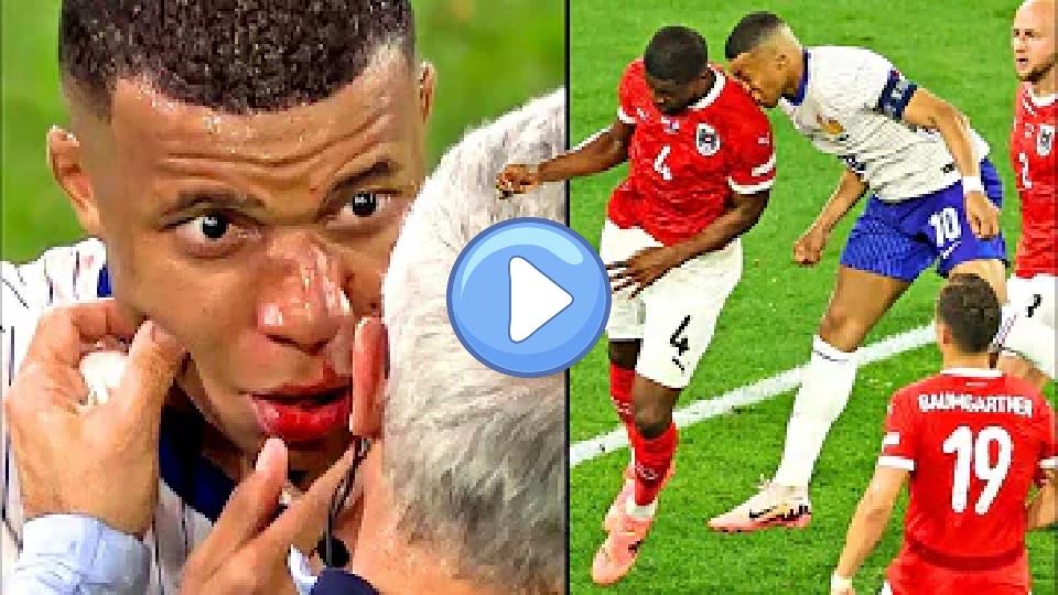 Play video: The Moment Kylian Mbappe Broke His Nose Against Austria 😳 | Euro 2024 | Griezmann's Head Injury | Reactions Video thumb: The Moment Kylian Mbappe Broke His Nose Against Austria 😳 | Euro 2024 | Griezmann's Head Injury | Reactions