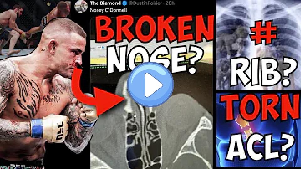 Play video: Doctor Explains Dustin Poirier's Multiple Injuries | Post UFC 302: Makhachev vs. Poirier Video thumb: Doctor Explains Dustin Poirier's Multiple Injuries | Post UFC 302: Makhachev vs. Poirier