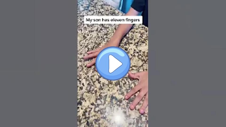Video thumb: My son has 11 fingers!