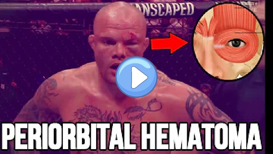 Video thumb: Doctor Reacts to Anthony Smith's Nasty Orbital Injury: UFC Singapore
