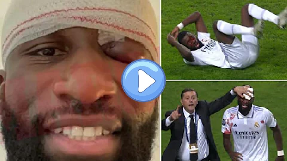 Video thumb: Antonio Rudiger Suffers Eye Injury Two Days Before El Clasico