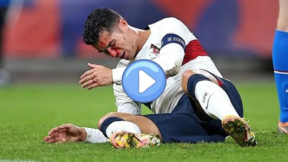 Play video: Cristiano Ronaldo's nose injury 😱 against the Czech Republic Video thumb: Cristiano Ronaldo's nose injury 😱 against the Czech Republic