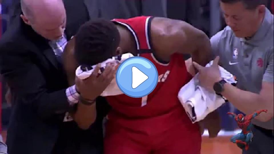 Video thumb: Kyle Lowry Suffers Severe Facial Injury